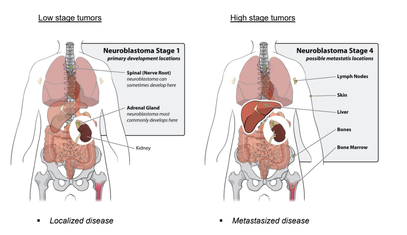 Figure 2: Low stage versus high stage neuroblastoma
