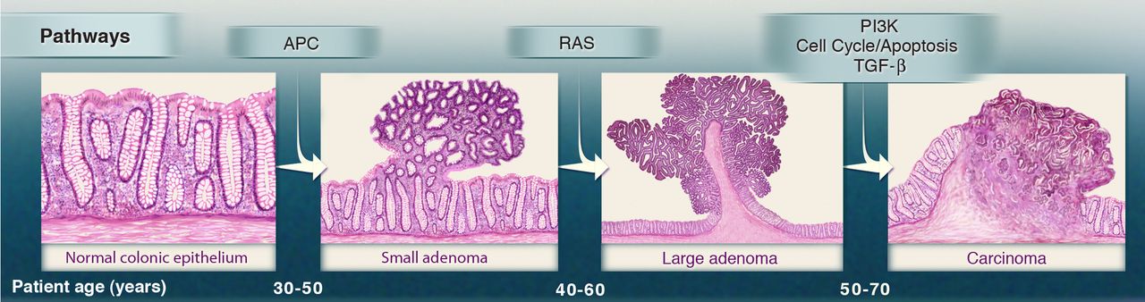 _images/genetic_alterations_and_the_progression_of_colorectal_cancer_fig2_e_cook.jpeg