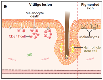 lesional (left side) and non-lesional (right side) vitiligo skin